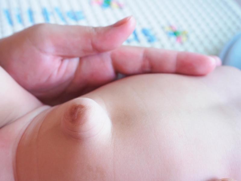 Herniorrafia umbilical