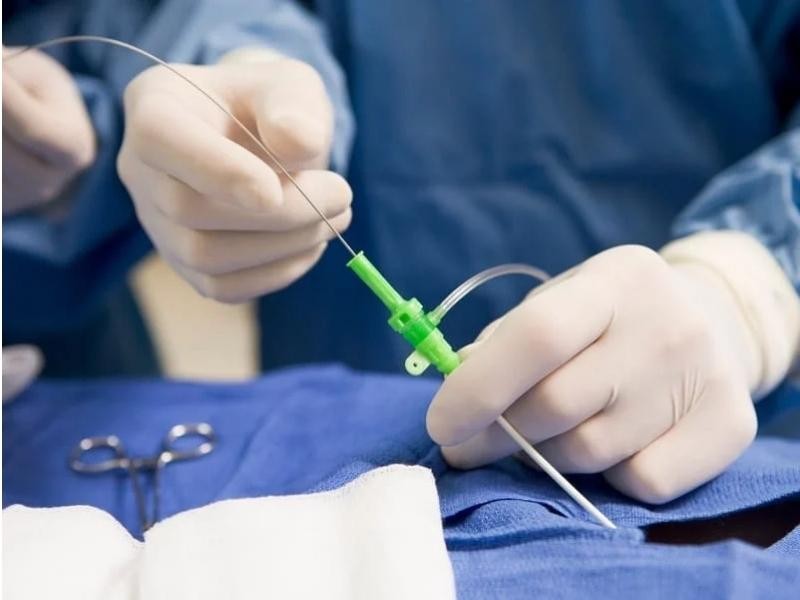 Tratamento endovascular de aneurisma cerebral