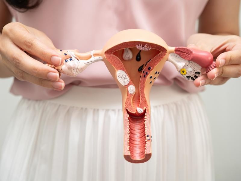 Embolização uterina para tratamento de miomas