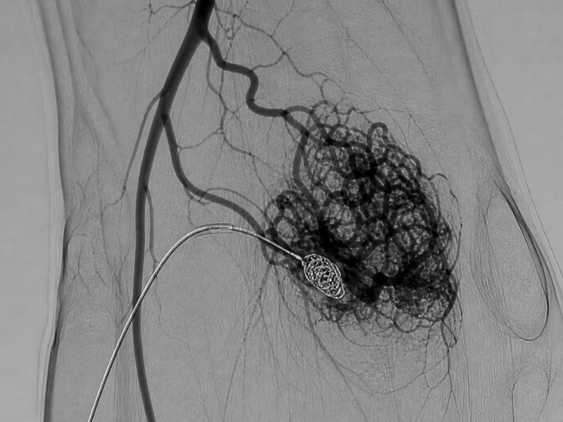 Embolização MAV (malformação arteriovenosa) periférica