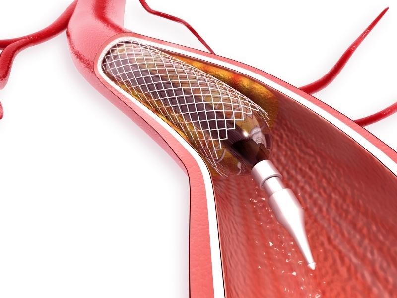 Angioplastia venosa central unilateral