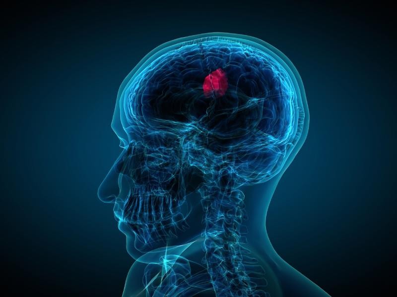 Embolização tumor cabeça e pescoço