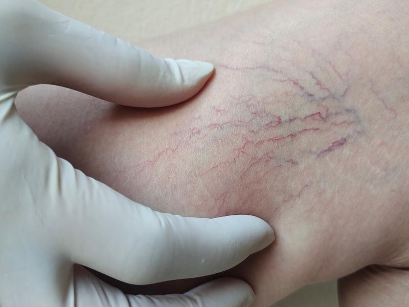 Varizes – tratamento cirúrgico de um membro com fibra à laser