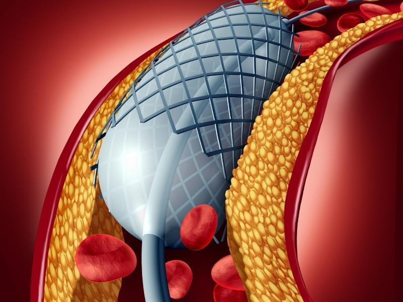 Angioplastia de membro superior unilateral