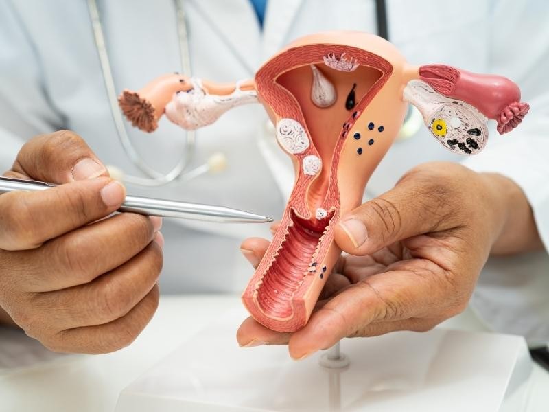 Ablação percutânea de mioma uterino