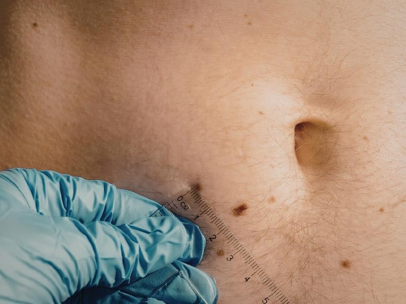 Biópsia de tecidos moles