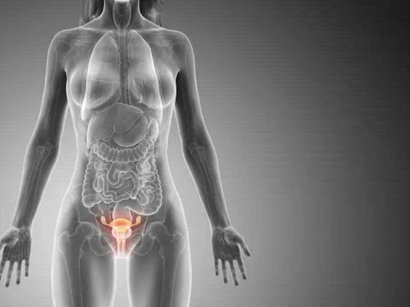 Embolização de Miomas Uterinos: Mioma e Fertilidade
