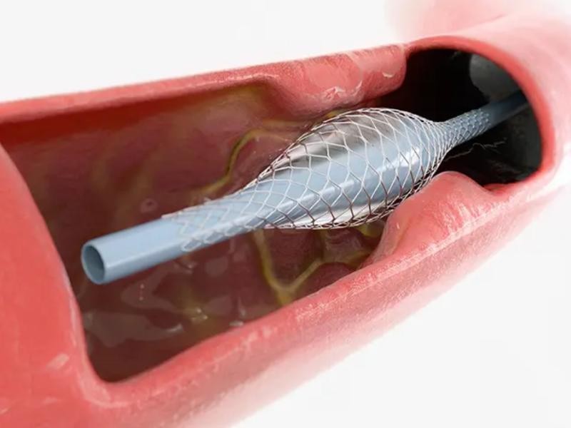 Saiba mais sobre angioplastia e arteriografia