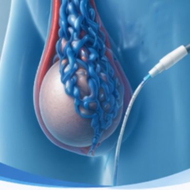 Embolização de Varicocele em Atibaia