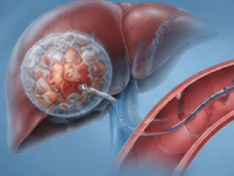 Embolização de Hemangioma
