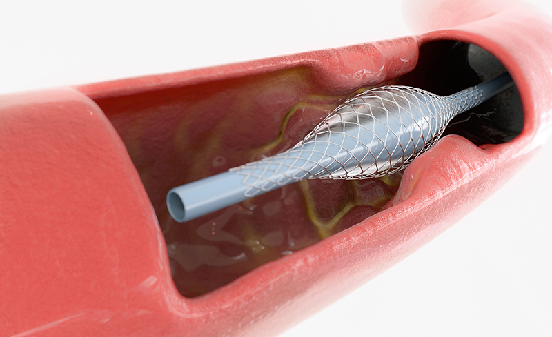 Cateterismo & Angioplastia